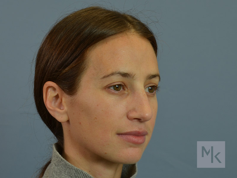 Rhinoplasty Before and After | Dr. Michael Kim