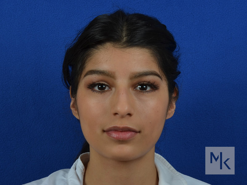 Rhinoplasty Before and After | Dr. Michael Kim