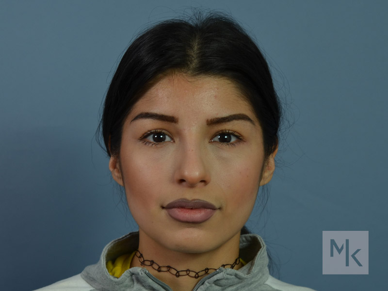Rhinoplasty Before and After | Dr. Michael Kim