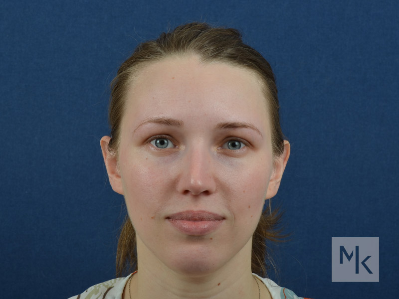 Rhinoplasty Before and After | Dr. Michael Kim