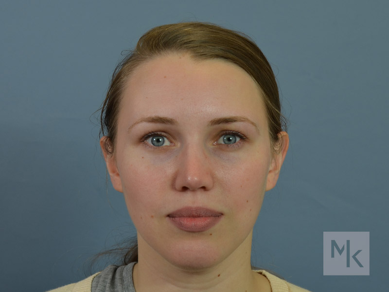 Rhinoplasty Before and After | Dr. Michael Kim