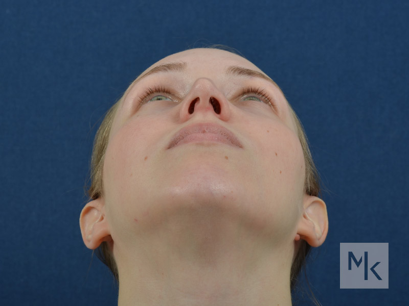 Rhinoplasty Before and After | Dr. Michael Kim