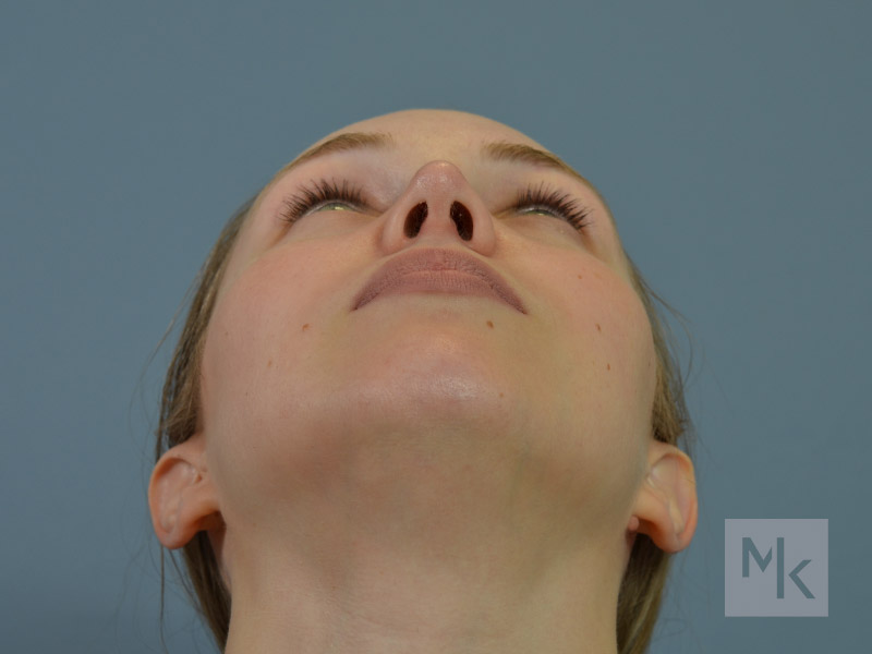 Rhinoplasty Before and After | Dr. Michael Kim