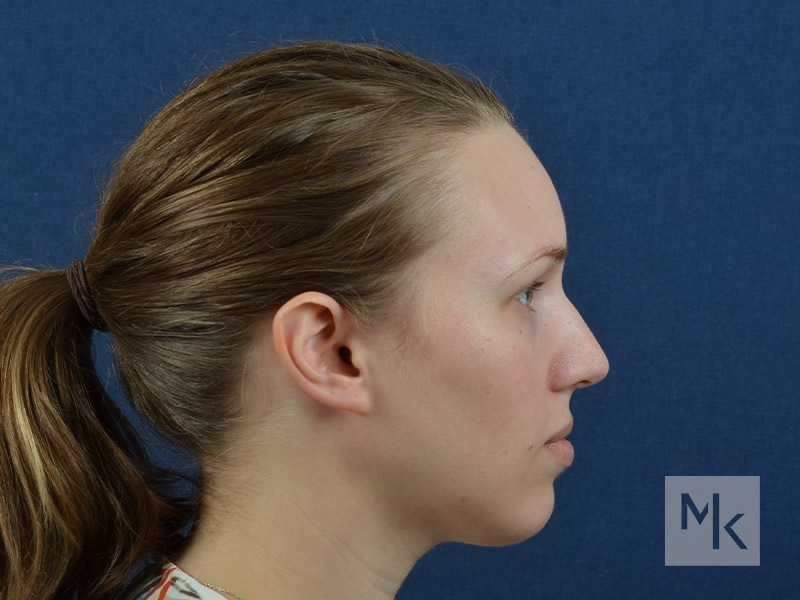 Rhinoplasty Before and After | Dr. Michael Kim