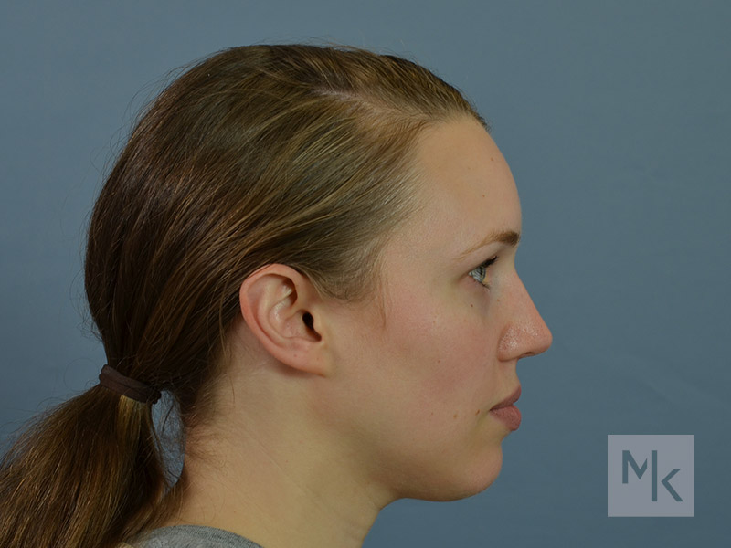 Rhinoplasty Before and After | Dr. Michael Kim