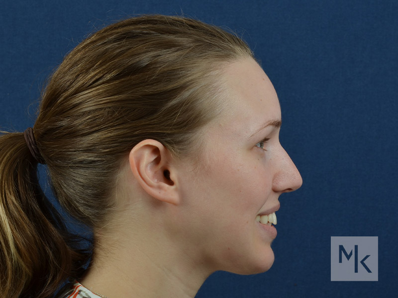 Rhinoplasty Before and After | Dr. Michael Kim