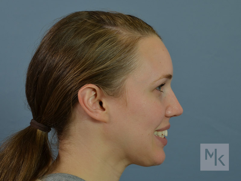 Rhinoplasty Before and After | Dr. Michael Kim