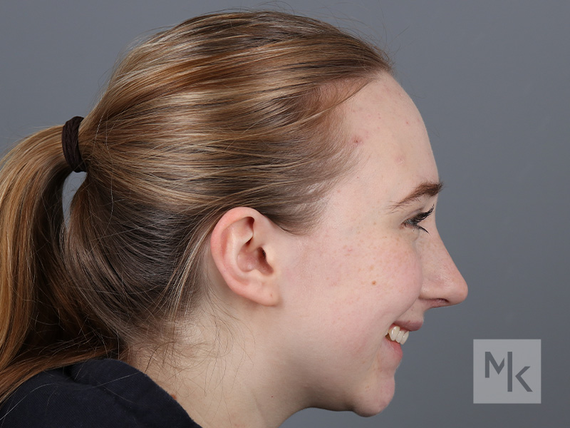 Rhinoplasty Before and After | Dr. Michael Kim