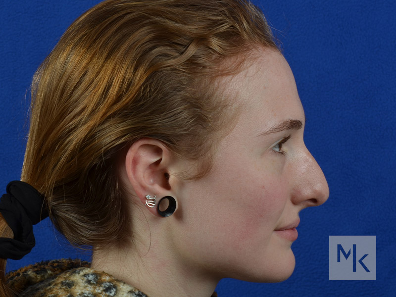 Rhinoplasty Before and After | Dr. Michael Kim