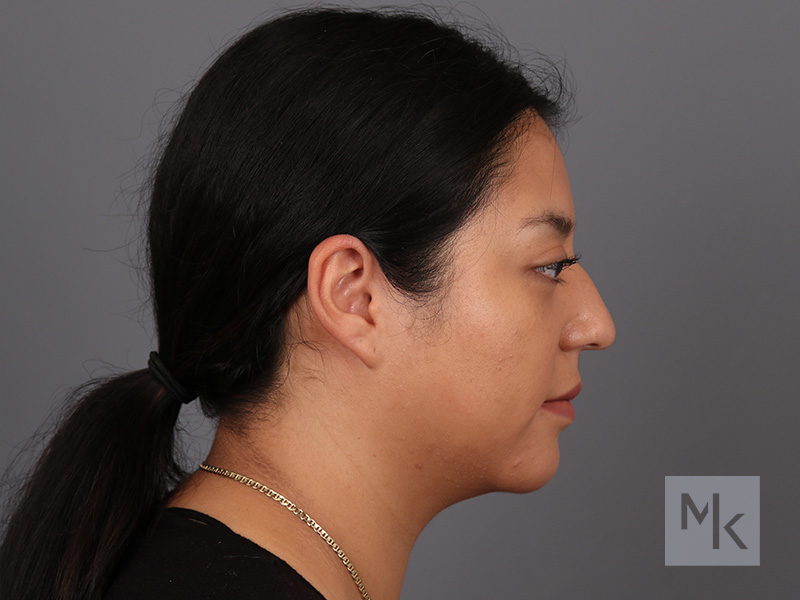 Submental Liposuction Before and After | Dr. Michael Kim