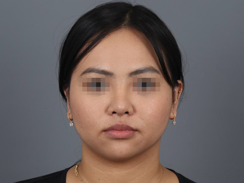 Submental Liposuction Before and After | Dr. Michael Kim
