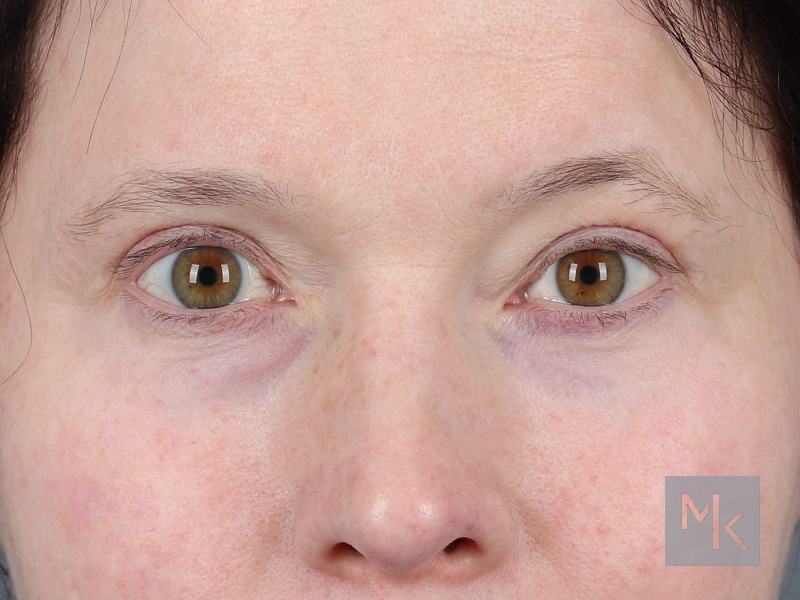 Upper Blepharoplasty Before and After | Dr. Michael Kim