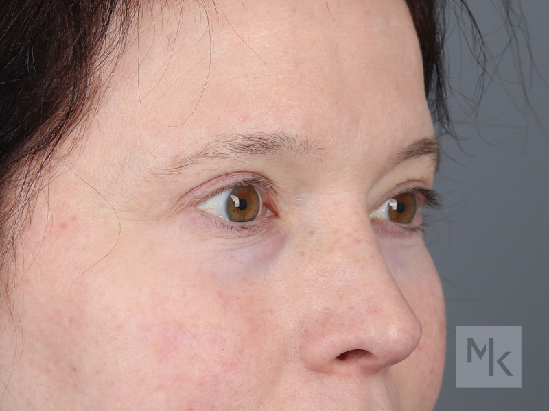 Upper Blepharoplasty Before and After | Dr. Michael Kim