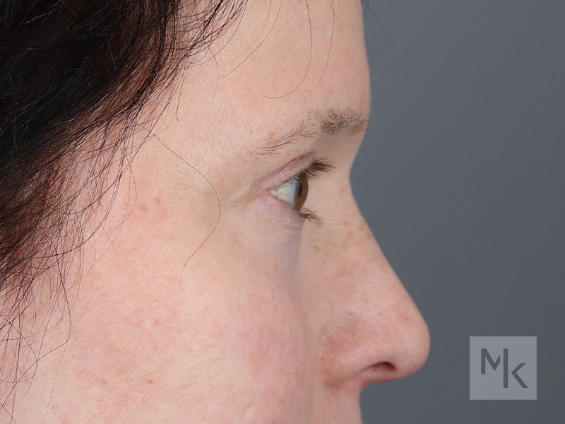 Upper Blepharoplasty Before and After | Dr. Michael Kim