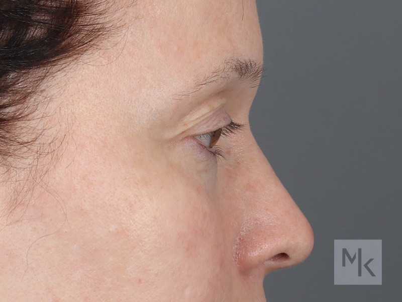 Upper Blepharoplasty Before and After | Dr. Michael Kim