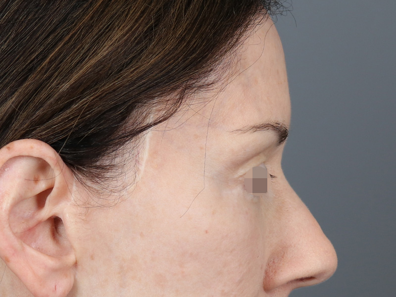 Upper Blepharoplasty Before and After | Dr. Michael Kim