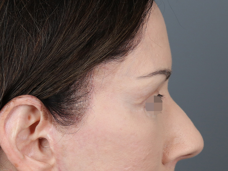 Upper Blepharoplasty Before and After | Dr. Michael Kim