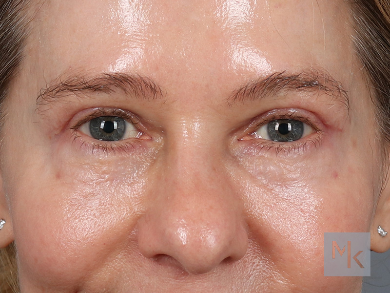 Upper Blepharoplasty Before and After | Dr. Michael Kim