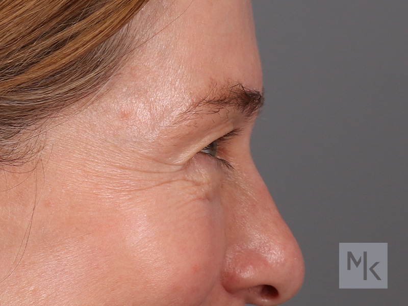 Upper Blepharoplasty Before and After | Dr. Michael Kim