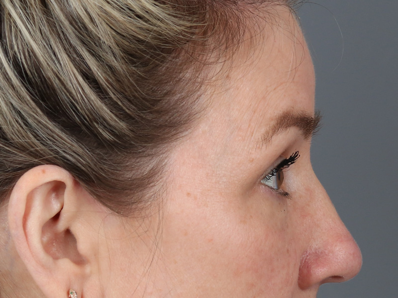 Upper Blepharoplasty Before and After | Dr. Michael Kim