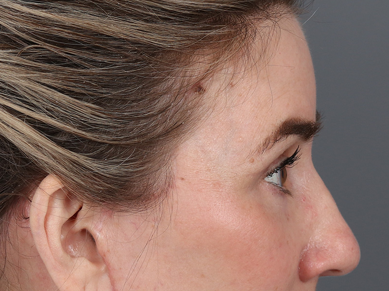 Upper Blepharoplasty Before and After | Dr. Michael Kim