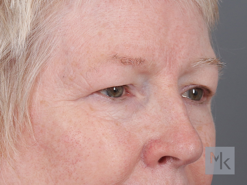 Upper Blepharoplasty Before and After | Dr. Michael Kim