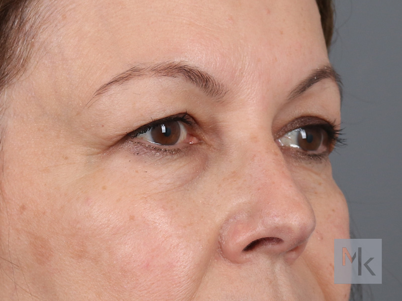 Upper Blepharoplasty Before and After | Dr. Michael Kim