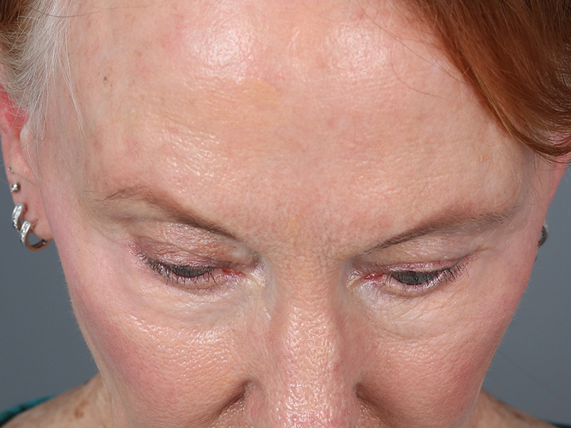 Upper Blepharoplasty Before and After | Dr. Michael Kim