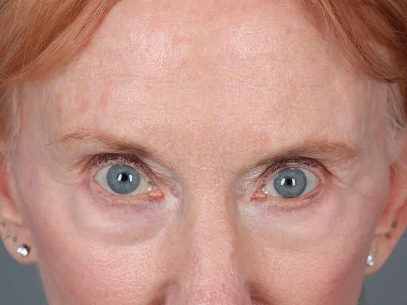 Upper Blepharoplasty Before and After | Dr. Michael Kim