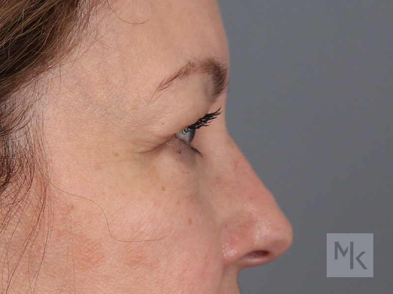 Upper Blepharoplasty Before and After | Dr. Michael Kim