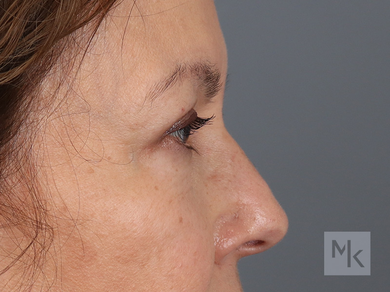 Upper Blepharoplasty Before and After | Dr. Michael Kim