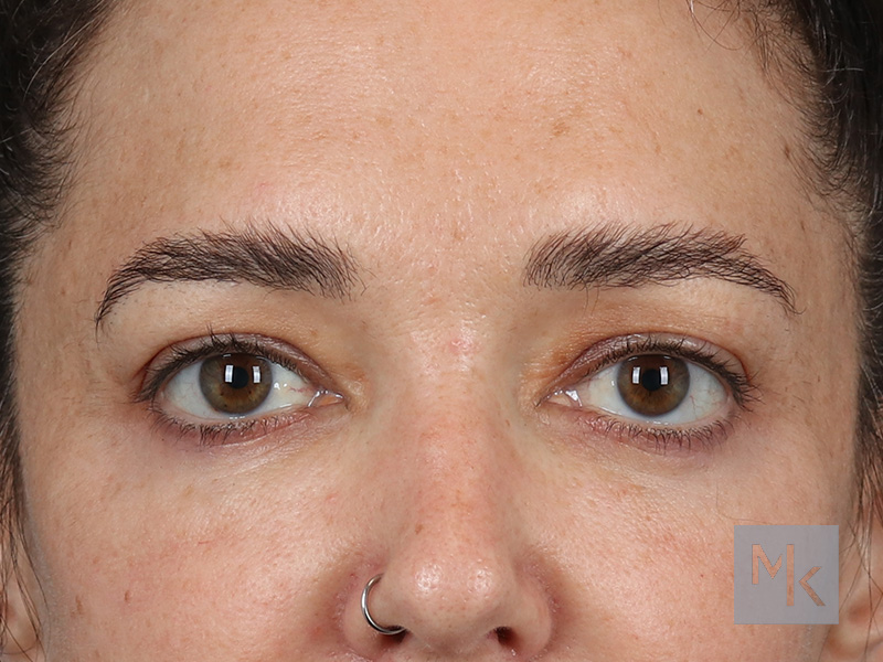 Upper Blepharoplasty Before and After | Dr. Michael Kim