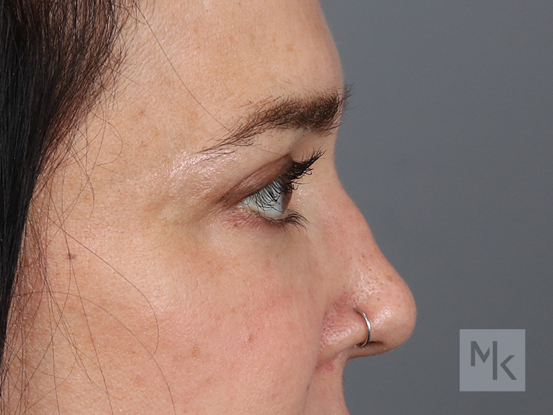 Upper Blepharoplasty Before and After | Dr. Michael Kim