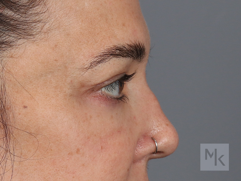 Upper Blepharoplasty Before and After | Dr. Michael Kim