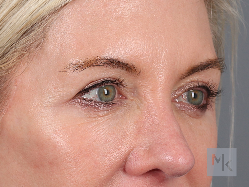 Upper Blepharoplasty Before and After | Dr. Michael Kim