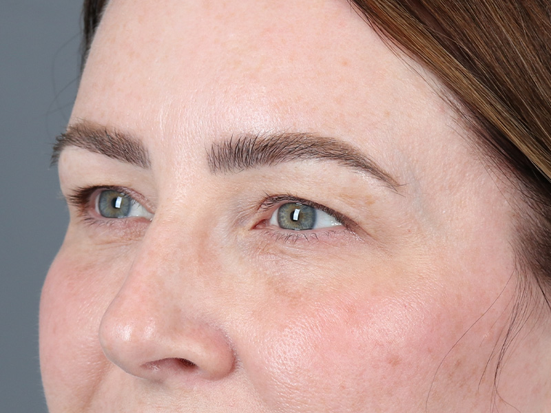 Upper Blepharoplasty Before and After | Dr. Michael Kim