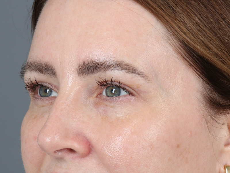 Upper Blepharoplasty Before and After | Dr. Michael Kim