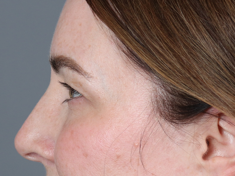 Upper Blepharoplasty Before and After | Dr. Michael Kim