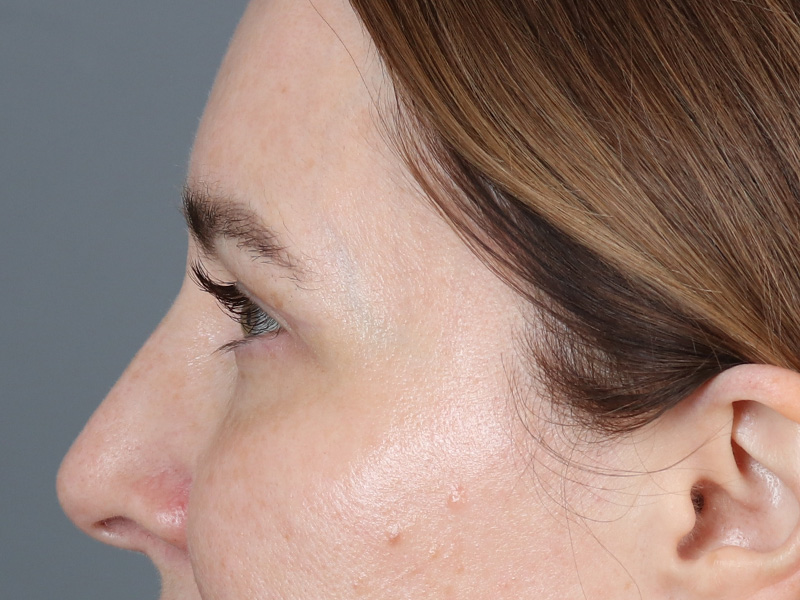 Upper Blepharoplasty Before and After | Dr. Michael Kim