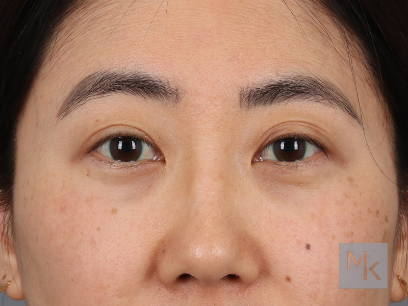 Upper Blepharoplasty Before and After | Dr. Michael Kim