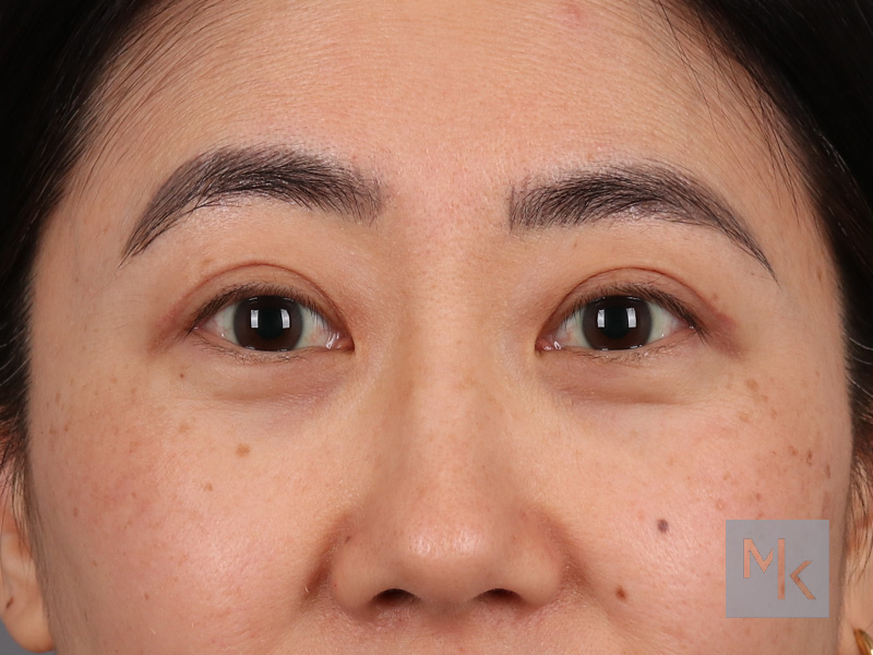 Upper Blepharoplasty Before and After | Dr. Michael Kim