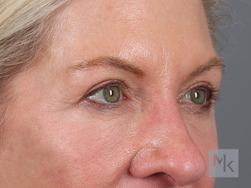 Upper Blepharoplasty Before and After | Dr. Michael Kim