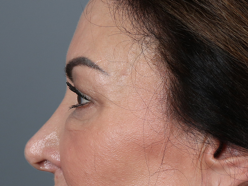Upper Blepharoplasty Before and After | Dr. Michael Kim