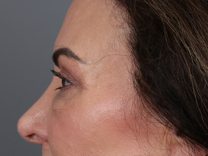 Upper Blepharoplasty Before and After | Dr. Michael Kim