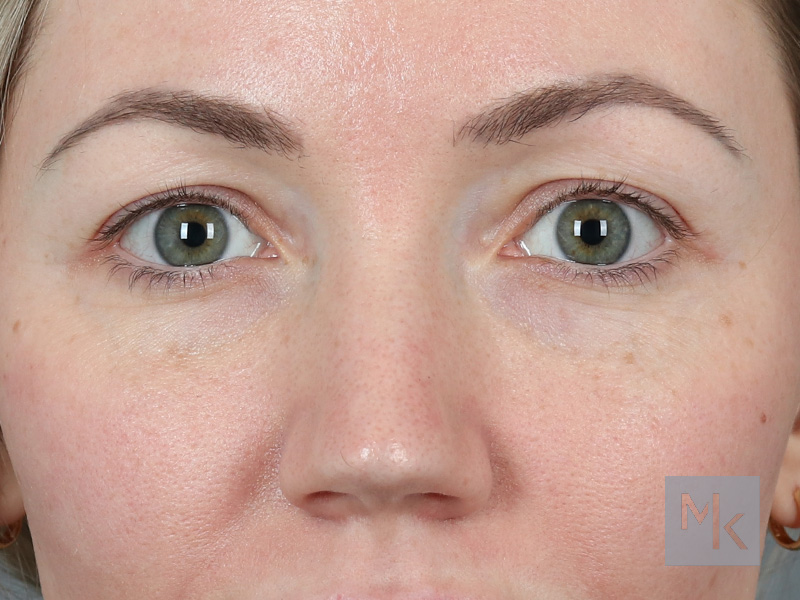 Upper Blepharoplasty Before and After | Dr. Michael Kim