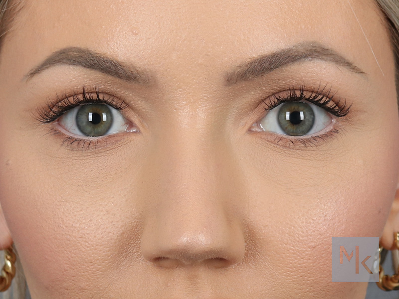 Upper Blepharoplasty Before and After | Dr. Michael Kim