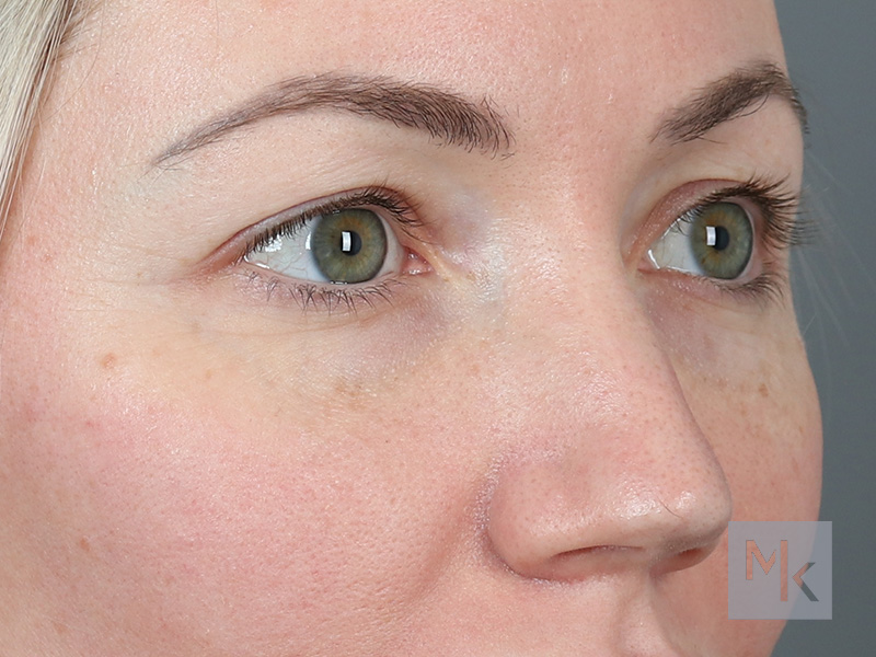 Upper Blepharoplasty Before and After | Dr. Michael Kim