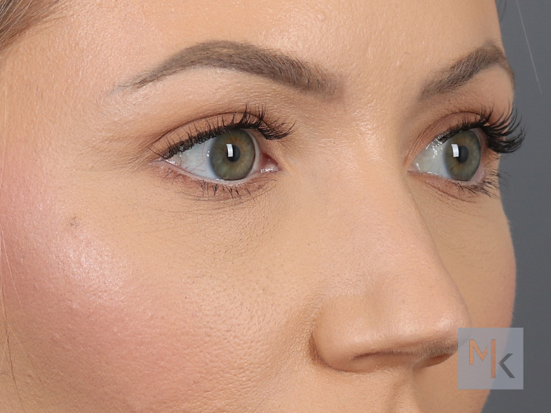 Upper Blepharoplasty Before and After | Dr. Michael Kim