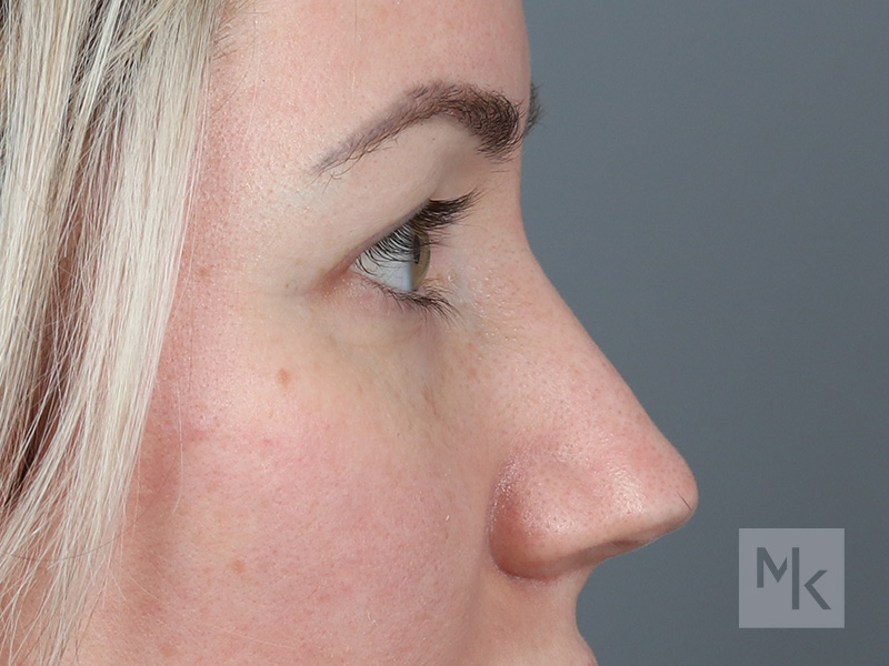 Upper Blepharoplasty Before and After | Dr. Michael Kim