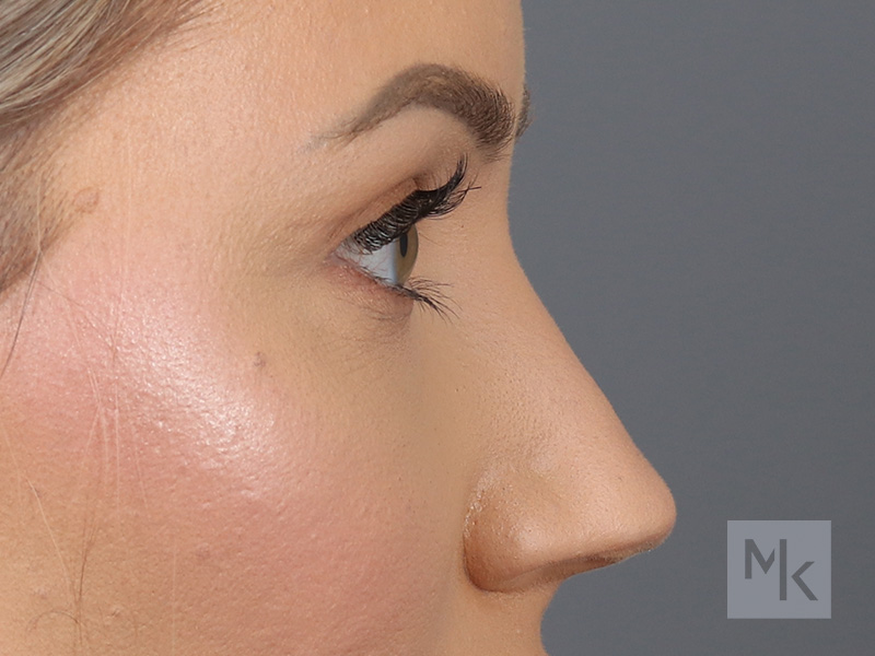 Upper Blepharoplasty Before and After | Dr. Michael Kim